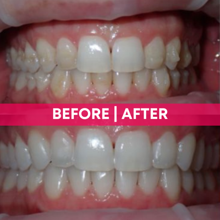 Before and afters