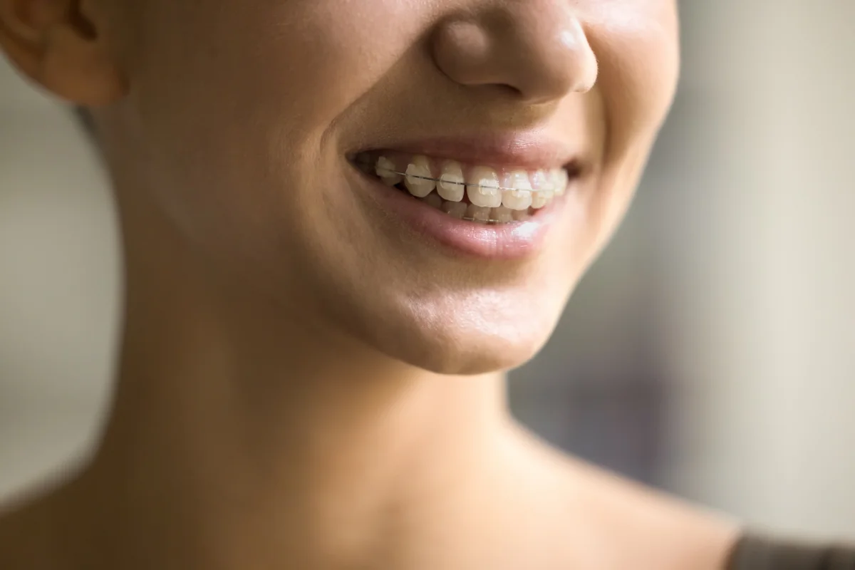 Ceramic Braces vs Invisalign® for Working Professionals Ceramic Braces vs Invisalign® for Working Professionals